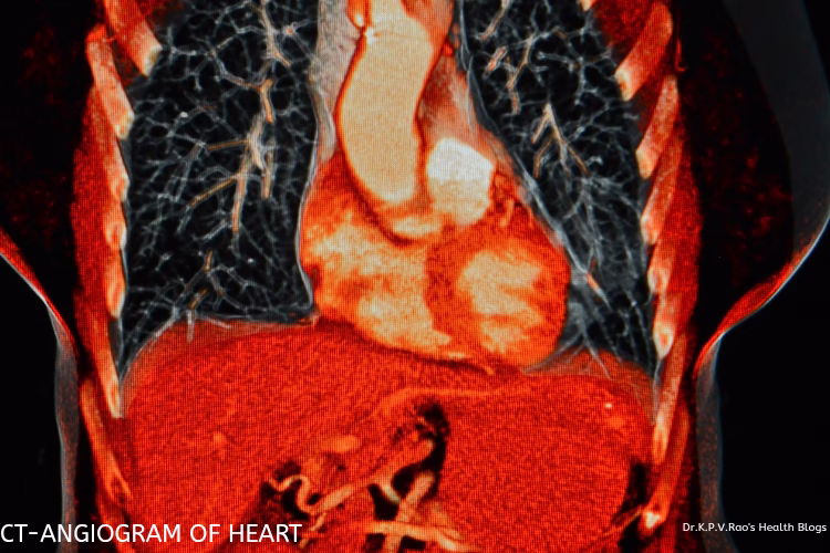 A Comprehensive Guide To CT-Angiogram Of...